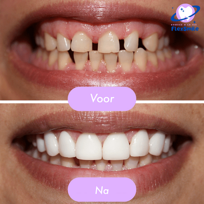 Flex-Smile® veneers